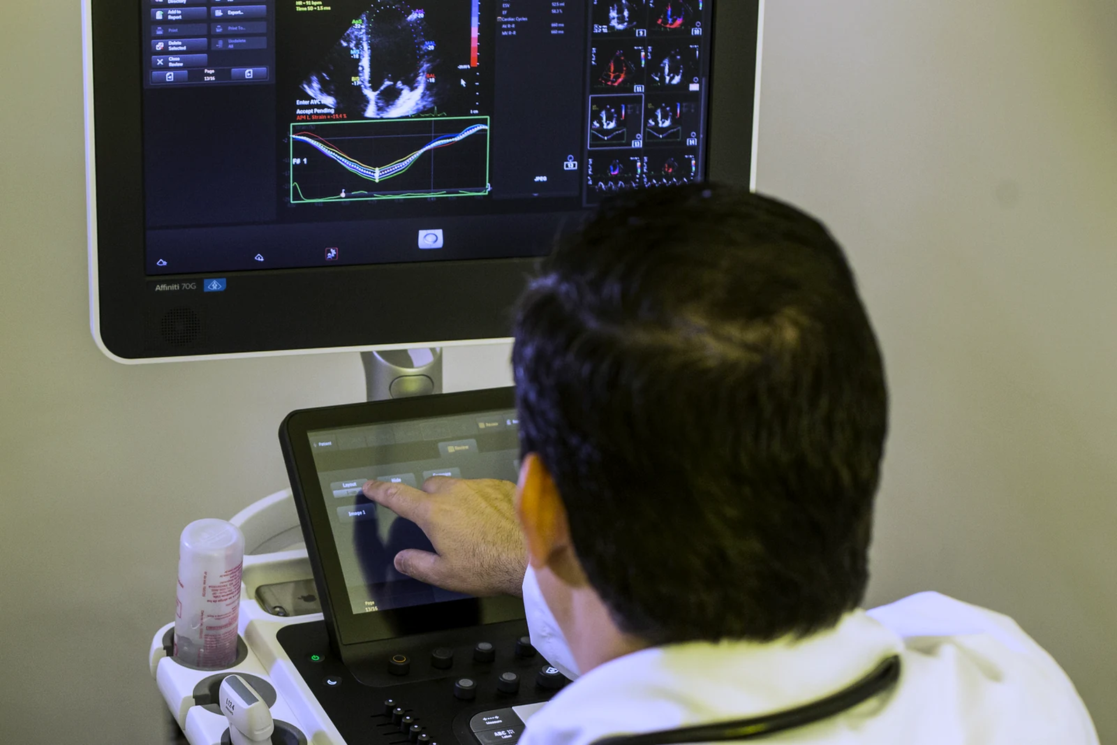 Monitor exibindo análise de strain miocárdico durante ecocardiograma na Cuore Integrative